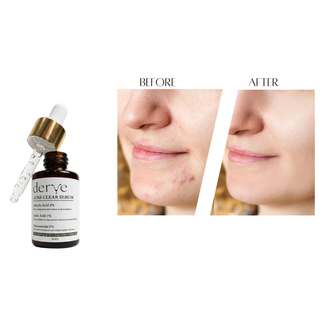 Acne Clear Serum